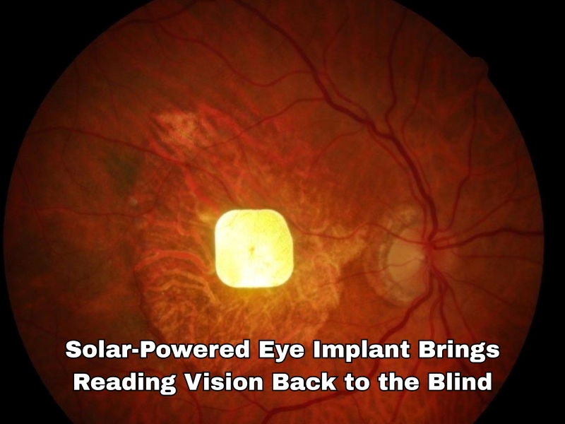 Solar-Powered Eye Implant Brings Reading Vision Back to the Blind